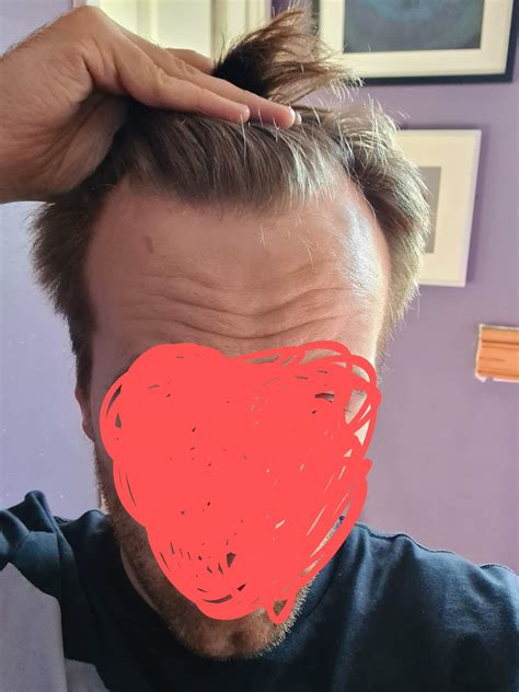 reddit receding hairline